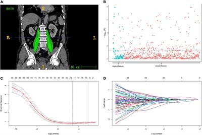 Establish a New Diagnosis of Sarcopenia Based on Extracted Radiomic Features to Predict Prognosis of Patients With Gastric Cancer